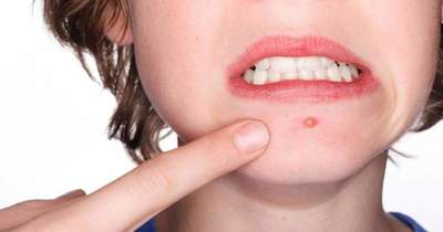 Savon pour l'acné: les actions et l'efficacité du principe de