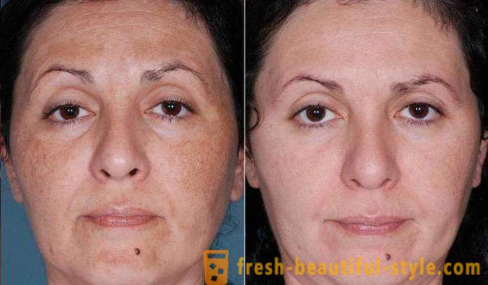 Peelings à l'acide pour le visage: les commentaires, les photos avant et après