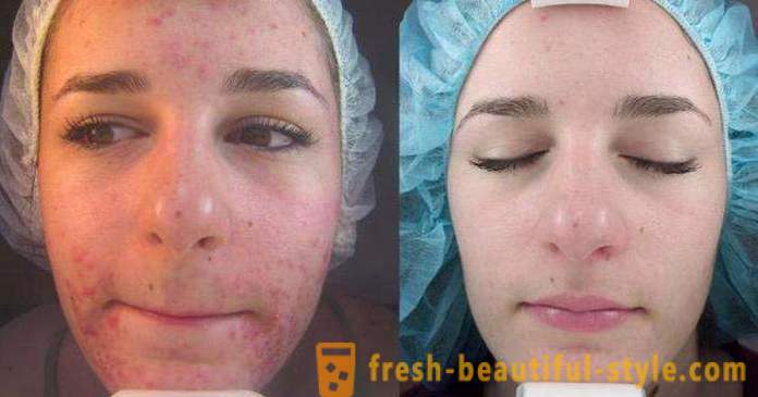 Peelings à l'acide pour le visage: les commentaires, les photos avant et après