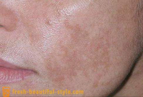 Les taches brunes sur le visage: les causes et les traitements. Les taches brunes