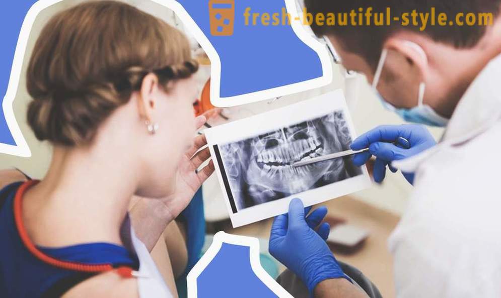 4 questions sur les implants dentaires