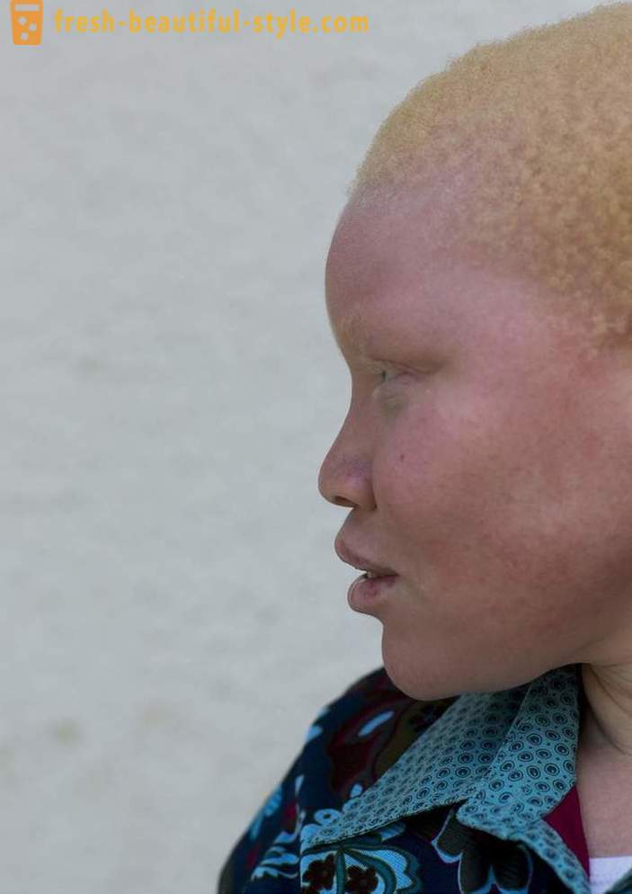 L'histoire tragique de Tanzanie albinos