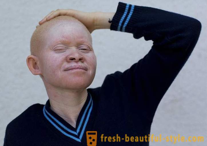 L'histoire tragique de Tanzanie albinos