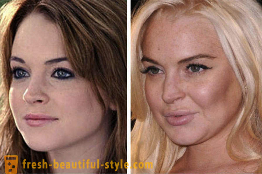 15 célébrités, mal finis avec Botox