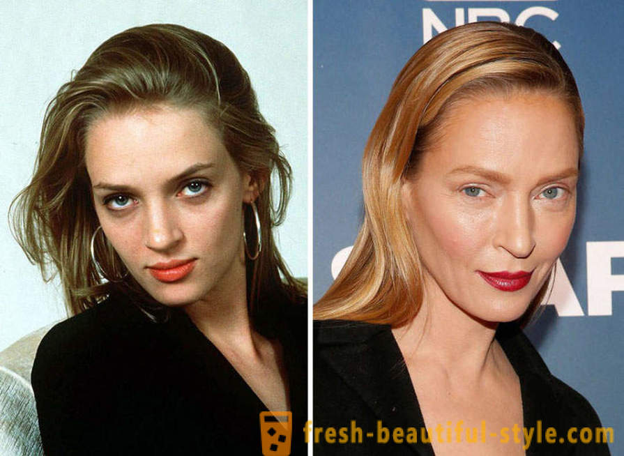 15 célébrités, mal finis avec Botox