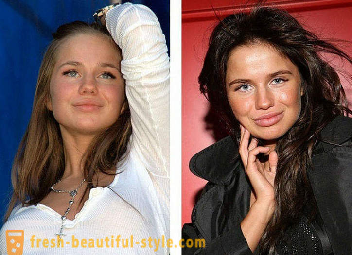 10 beautés russes avant et après plastique