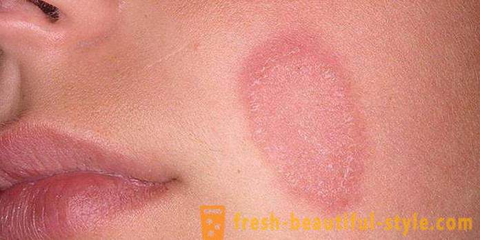 La peau squameuse sur le visage et les mains: les causes possibles et les caractéristiques des soins