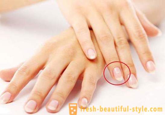 Des taches blanches sur les ongles des doigts: les causes et le traitement