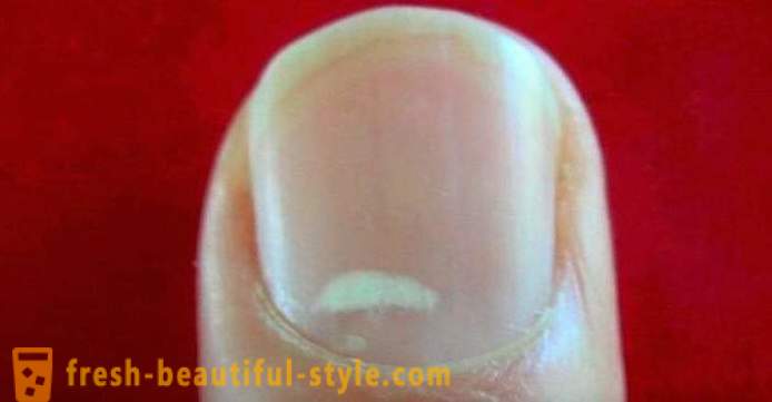 Des taches blanches sur les ongles des doigts: les causes et le traitement