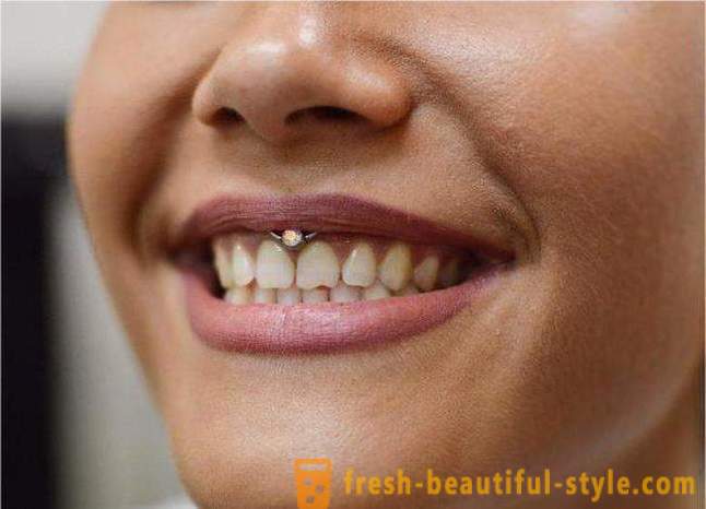 Piercing « smiley » - une crevaison sous la lèvre frenulum: après, commentaires