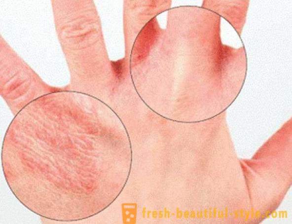 La peau sèche des mains: Causes. Peaux très sèches, ce qu'il faut faire?