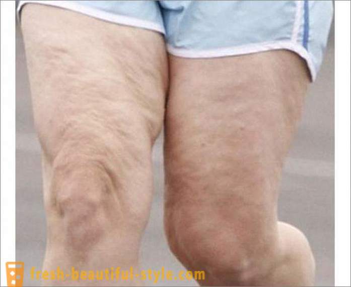 Comment se débarrasser de la cellulite sur les jambes? Exercices pour les jambes de la cellulite
