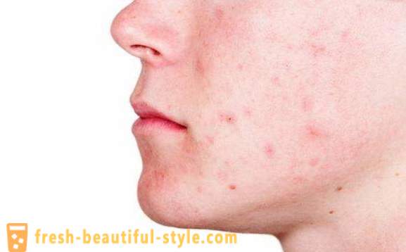 Se débarrasser de l'acné et des traces d'entre eux. Comment se débarrasser de l'acné sur les différentes zones de la peau
