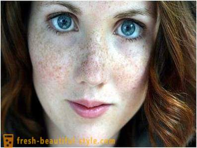 Prenez soin de leur beauté et de la jeunesse: origine de la pigmentation sur le visage