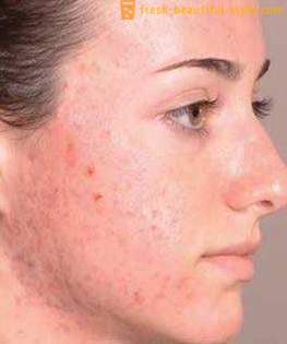 Comment se débarrasser des traces après l'acné et restaurer la peau belle vue?
