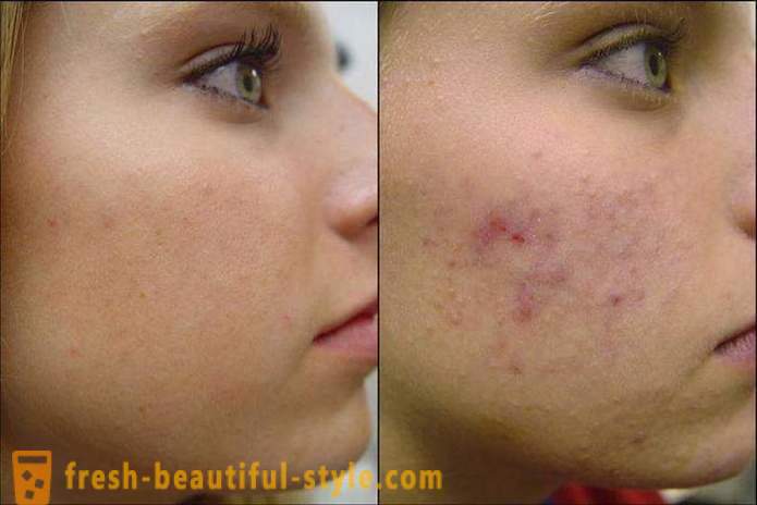 Comment nettoyer votre visage de l'acné afin qu'ils ne sont plus retournés